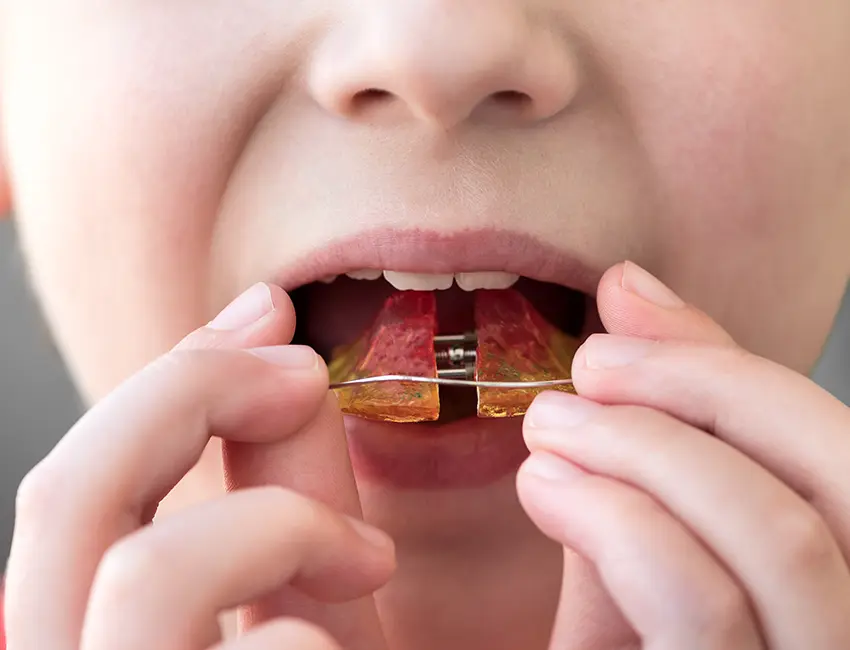 Orthodontic Retention in Carlsbad, CA