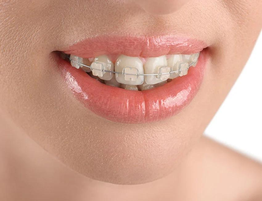 Teen with clear braces in Carlsbad, CA