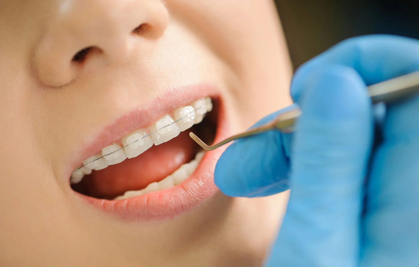 Braces process check in Carlsbad, CA