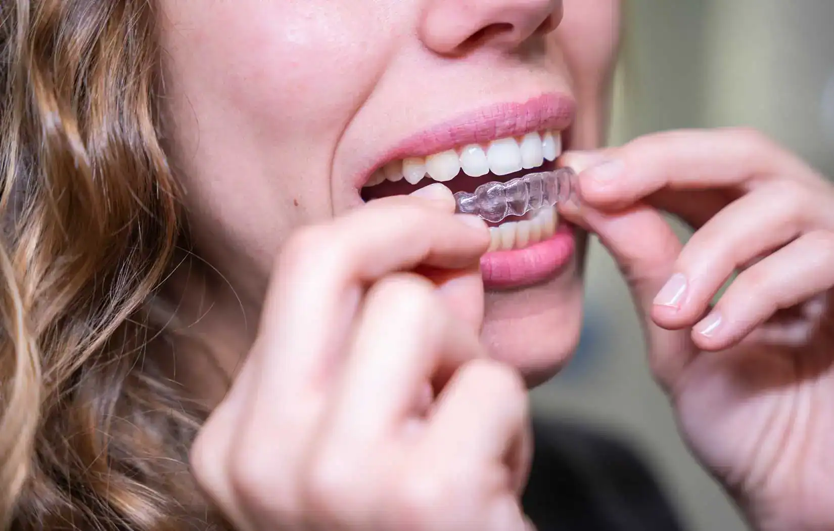 Patient putting on clear aligners