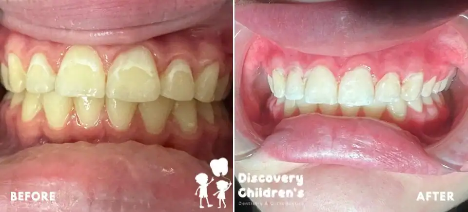 Icon Resin Infiltration | Carlsbad, CA | Discovery Children's Dentistry