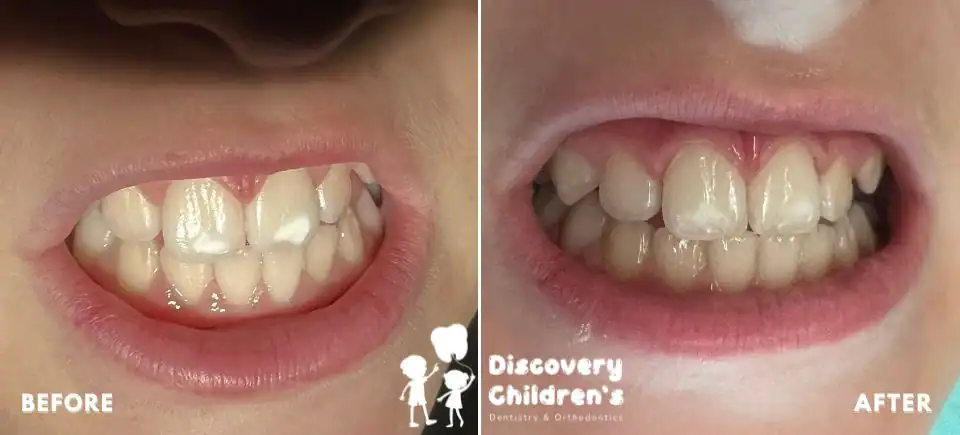 Icon Resin Infiltration | Carlsbad, CA | Discovery Children's Dentistry
