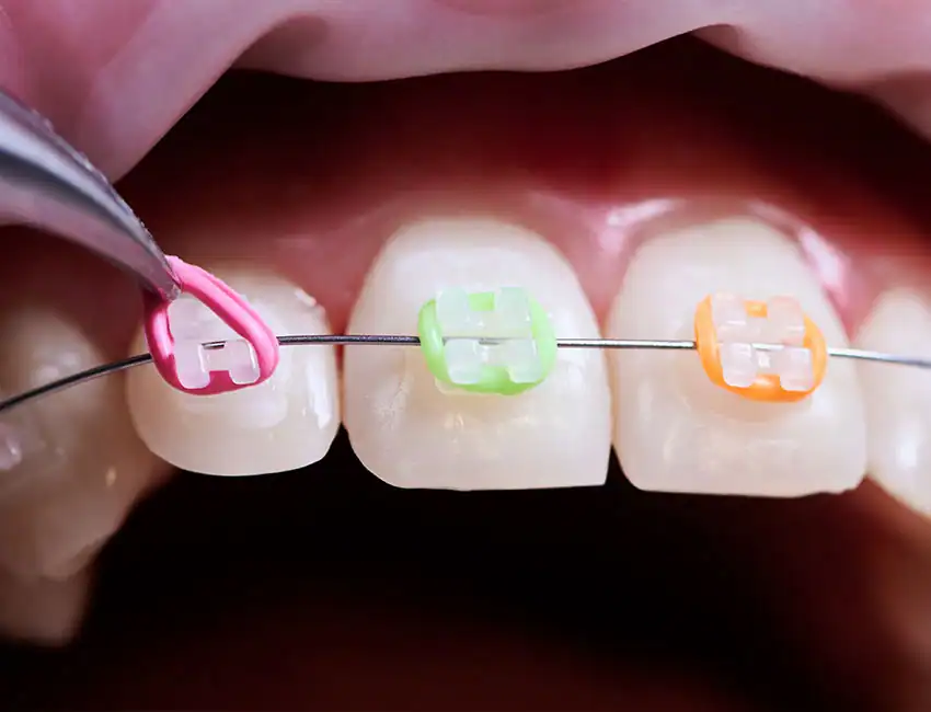 orthodontics white braces