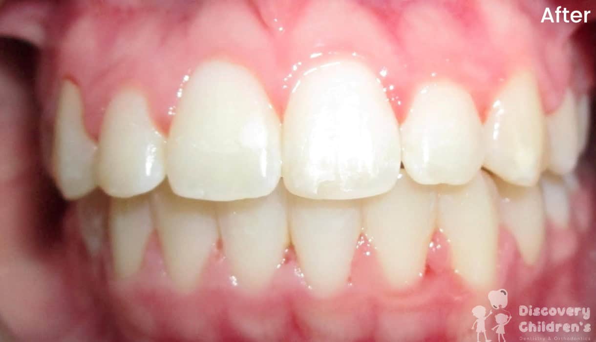 Before and after orthodontic treatment showing improved tooth alignment at Discovery Children's Dentistry.
