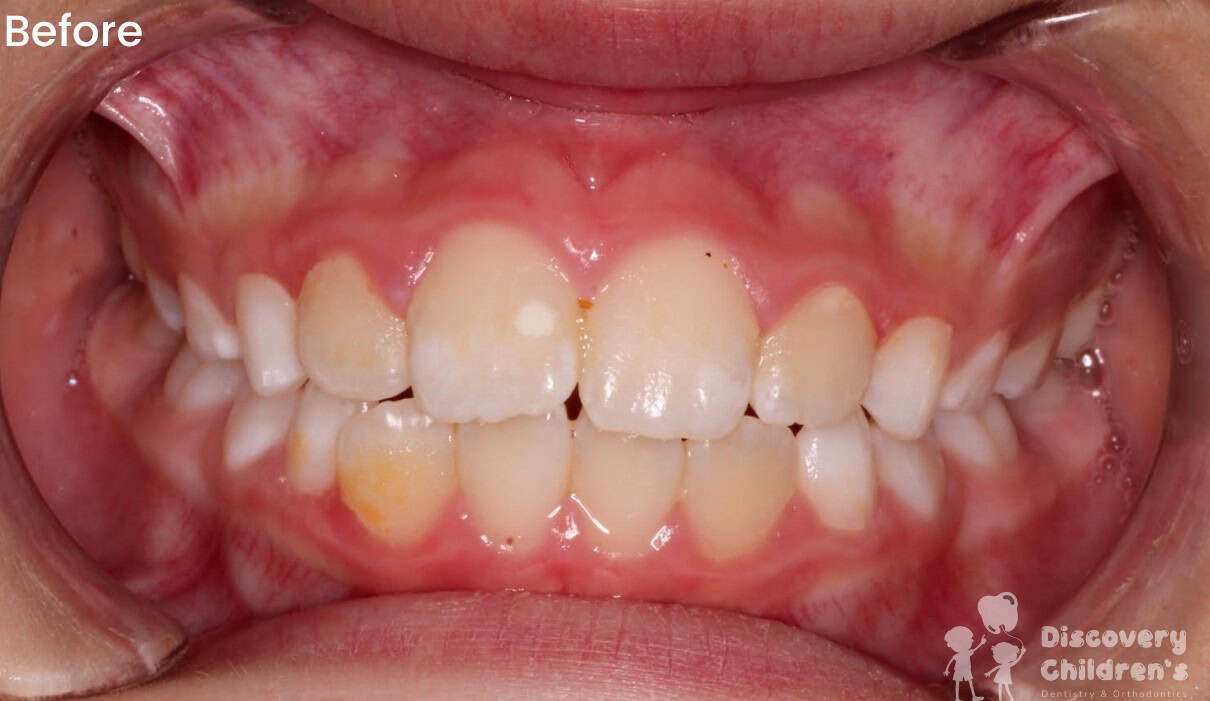 Before and after orthodontic treatment showing improved tooth alignment at Discovery Children's Dentistry.