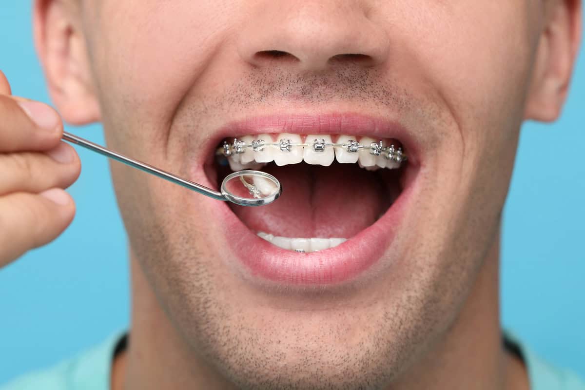 Adult Orthodontic In Calsbad Adult patient having metal braces examined with a dental mirror.