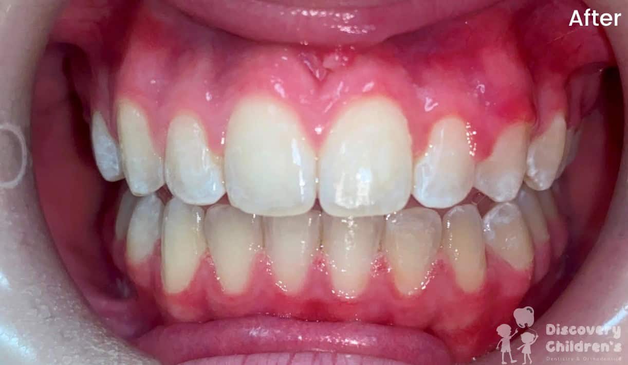 Orthodontic treatment before and after showing straighter teeth and improved smile alignment.