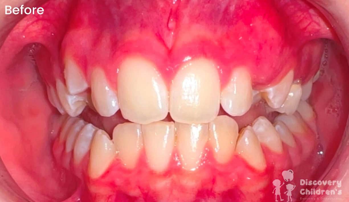 Orthodontic treatment before and after showing straighter teeth and improved smile alignment.