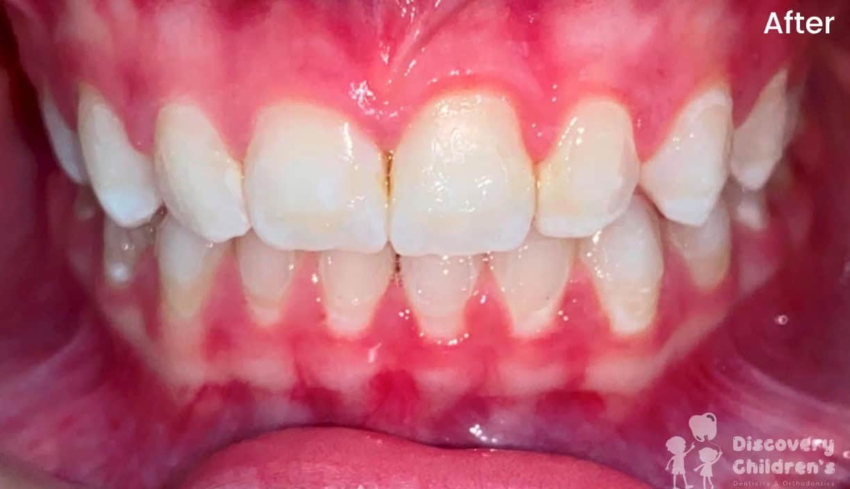 Before and after results of orthodontic treatment for a pediatric patient at Discovery Children's Dentistry.