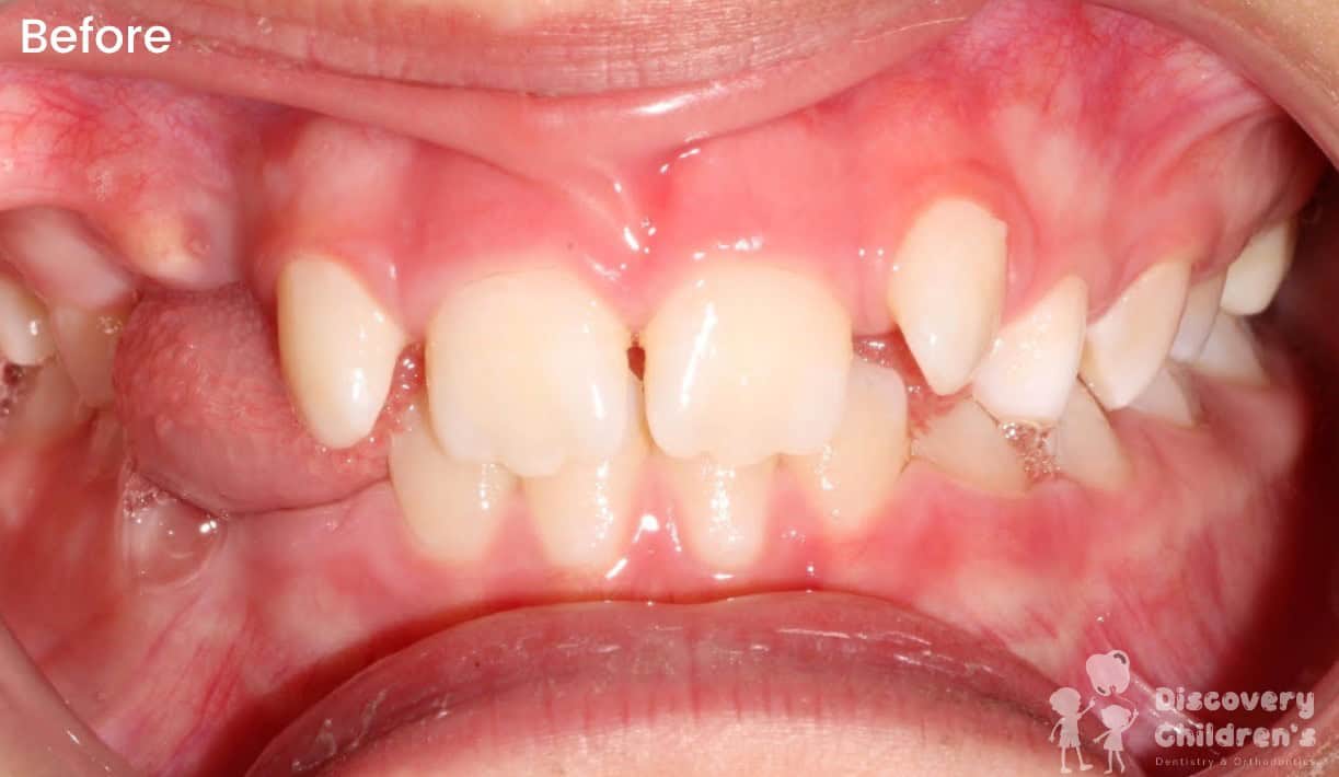 Before and after results of orthodontic treatment for a pediatric patient at Discovery Children's Dentistry.