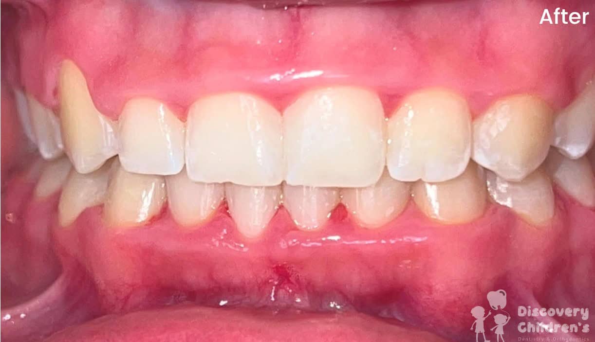 Orthodontic before and after showing improved alignment and appearance of the teeth.