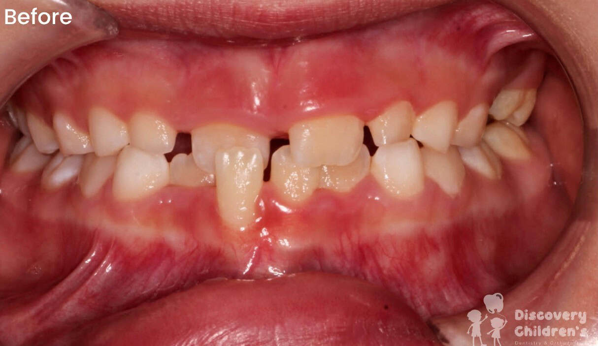 Orthodontic before and after showing improved alignment and appearance of the teeth.
