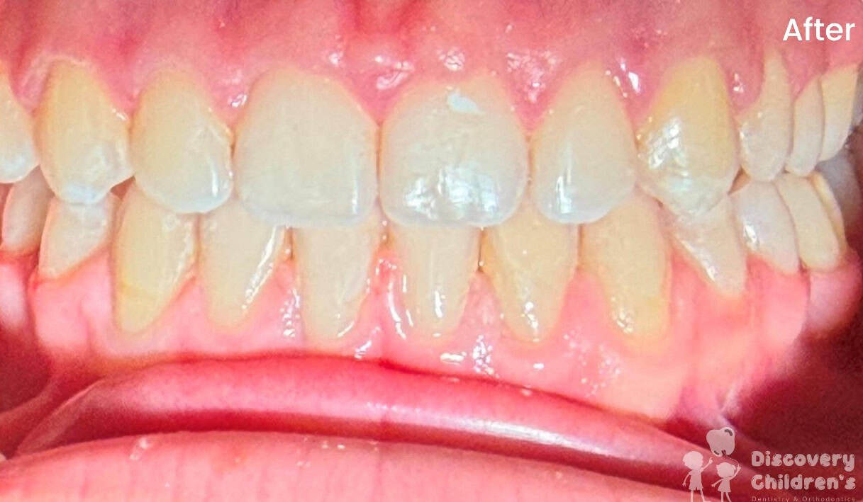 Pediatric orthodontic treatment results showing the smile before and after treatment.