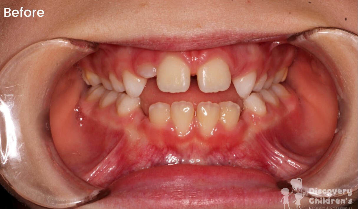 Pediatric orthodontic treatment results showing the smile before and after treatment.